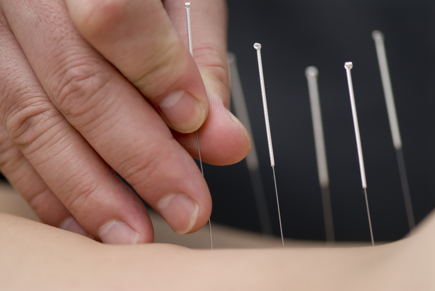 La acupuntura en el mundo actual: una opción a considerar